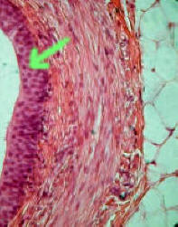 Transitional Epithelium From the Ureter